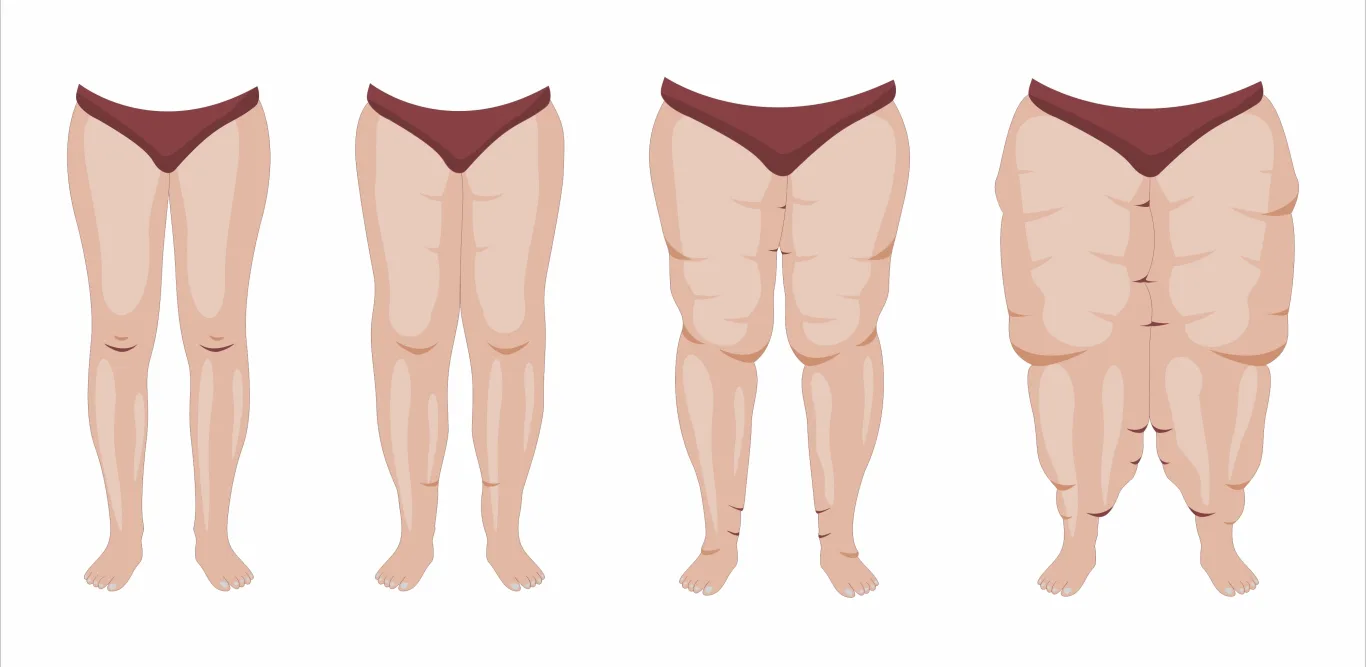 Illustration von vier Beinpaaren von vorne im Vergleich, von schlanker Form bis zunehmend verdickt, Darstellung der fortschreitenden, unverhältnismäßigen Fettverteilung beim Lipödem an Hüften, Oberschenkeln und Unterschenkeln.